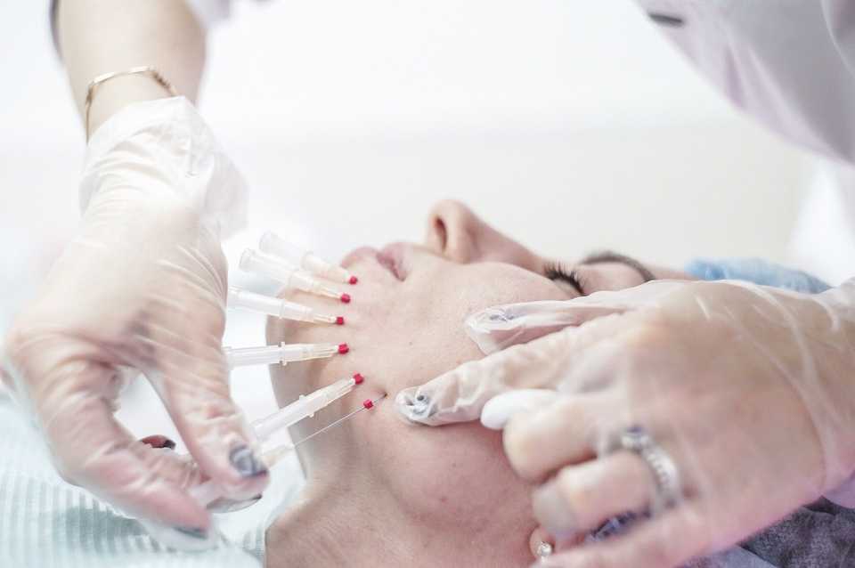 Постановка лифтинговых нитей