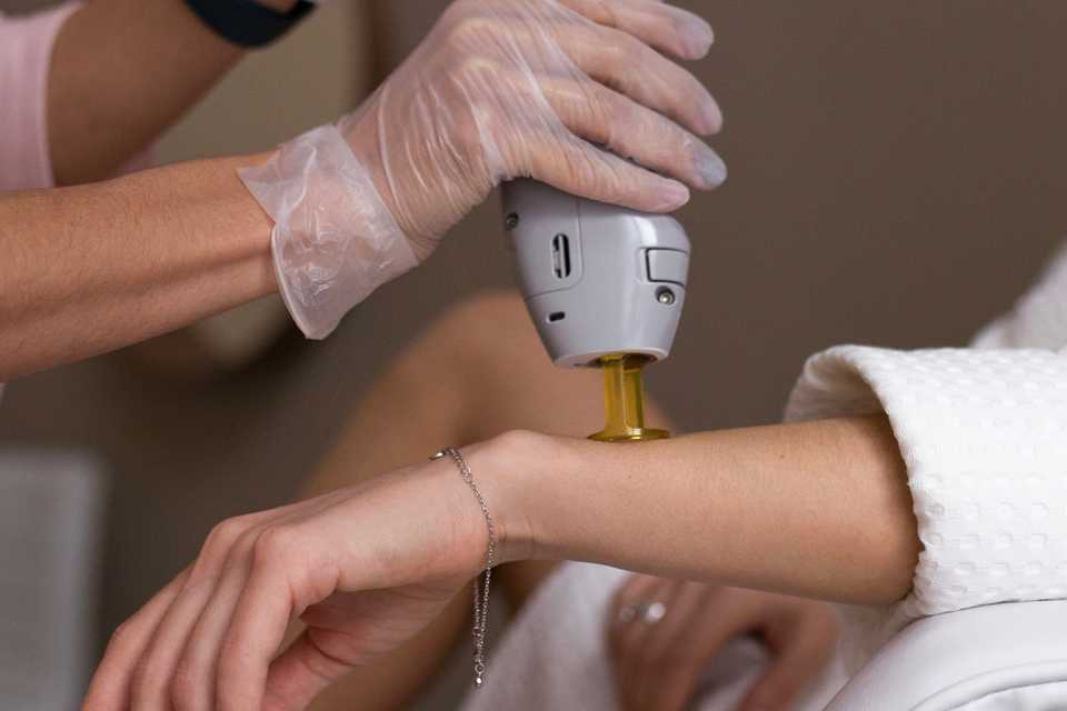 врач удаляет волосы на руке пациента Александритовым лазером