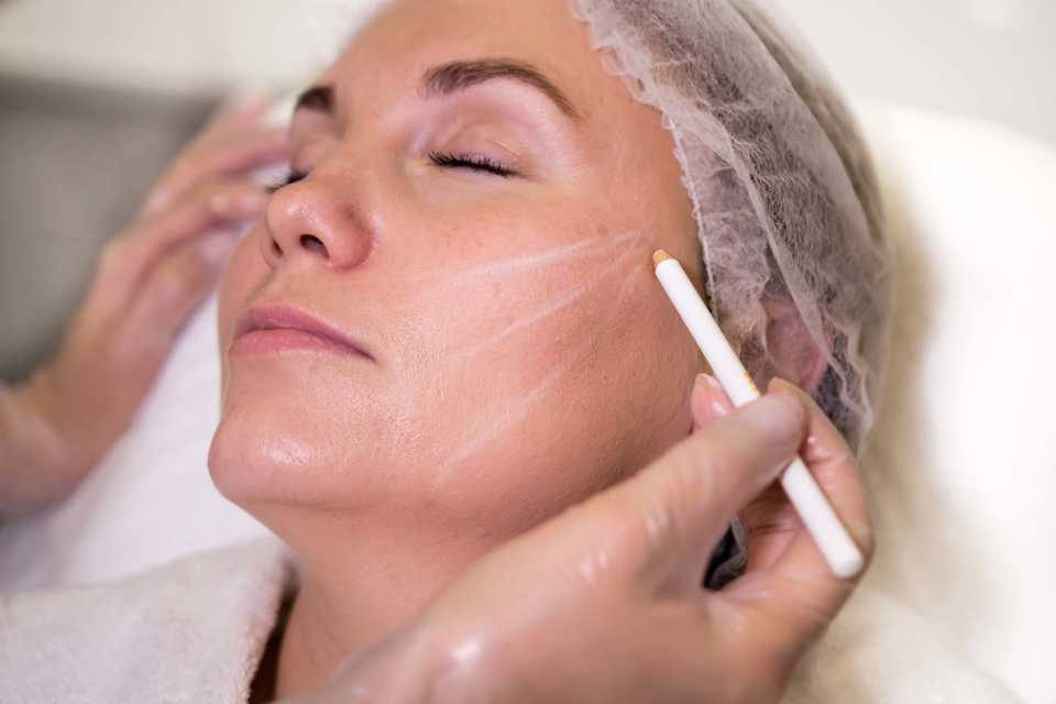 Нитевой лифтинг Spring Thread