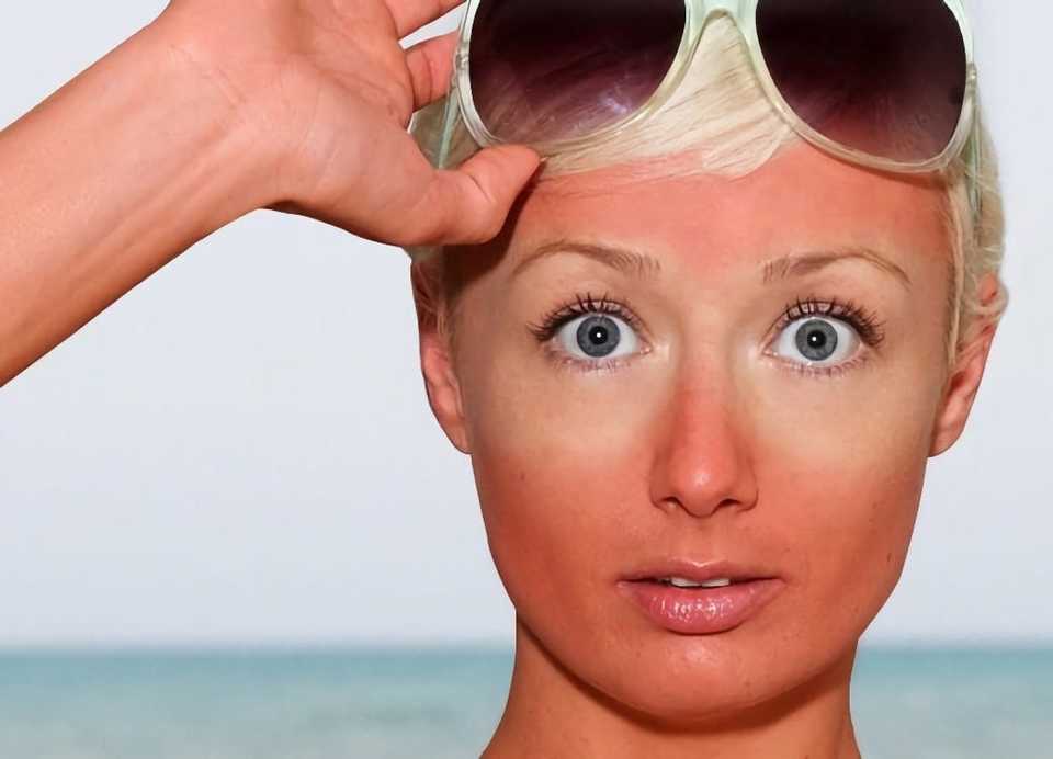 face sunburn