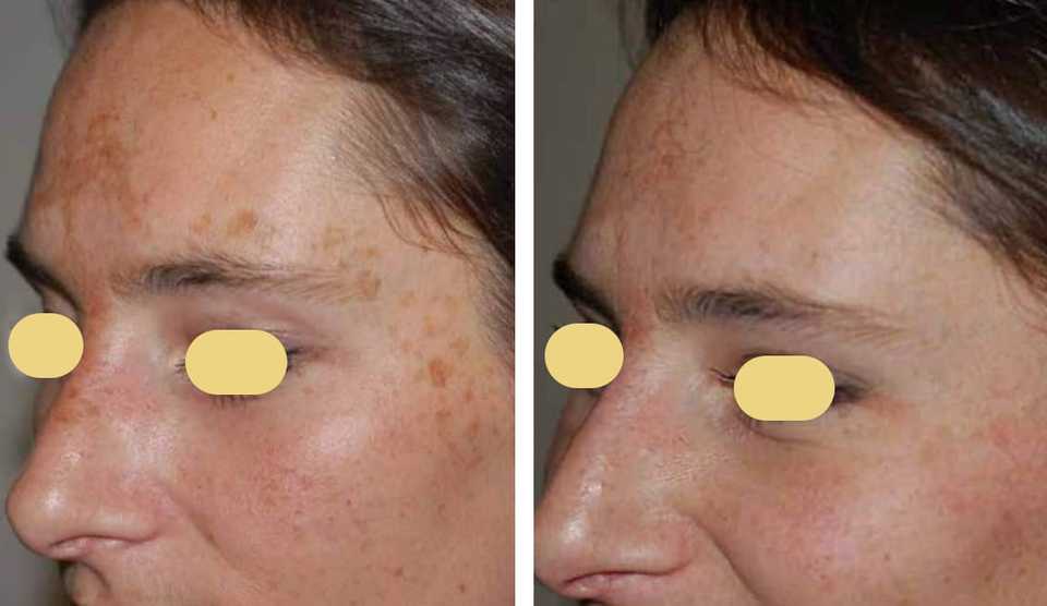 Наглядный результат до и после удаления пигментных пятен