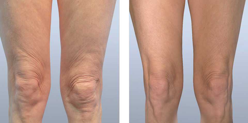 результат лифтинга после безоперационной липосакции