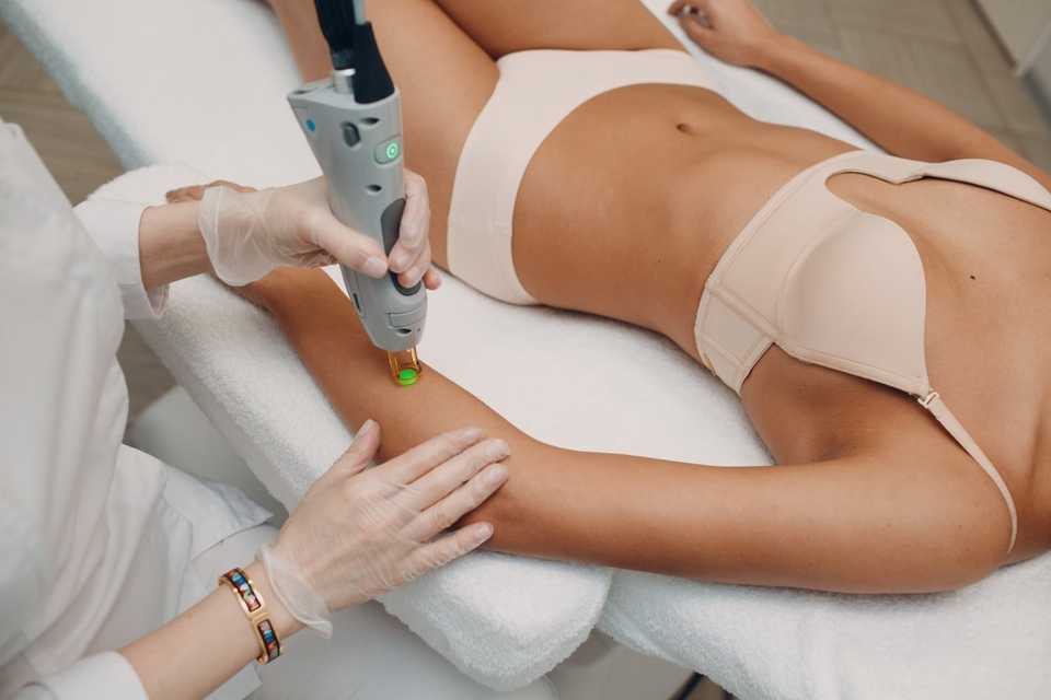 laser epilation procedure