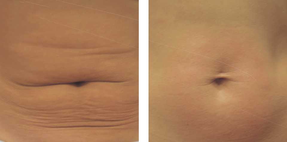 результат лифтинга после безоперационной липосакции