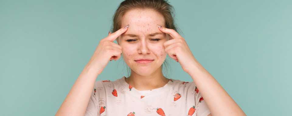 Подросток с угревой сыпью на лице