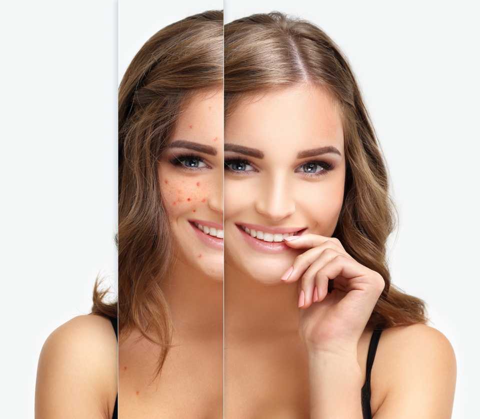 Избавление от прыщей на лице