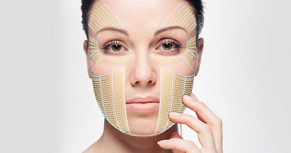 Количество линий в SMAS лифтинге