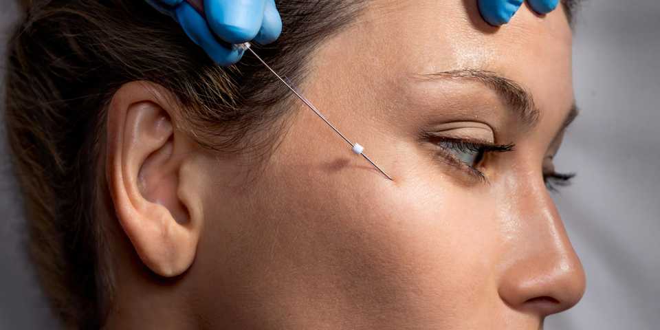 Косметолог вводит нить под кожу лица