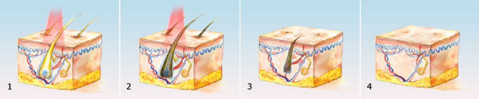 laser epilation process